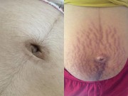 Bà bầu - Chuyện “biến dạng cơ thể” mẹ bầu nào cũng sợ nhưng vẫn chấp nhận để sinh con