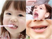 Làm mẹ - Chăm sóc răng cho con sai cách, chẳng mấy chốc bé sẽ “móm cả hàm”
