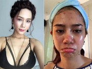 Làm đẹp - Trước khi có ý định lăn kim, bạn nên ngó qua những hậu quả đáng sợ này