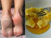 Làm đẹp - Gót chân nứt nẻ sẽ khỏi ngay chỉ bằng một quả chuối chín