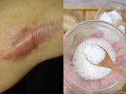 Làm đẹp - Tất tần tật các công thức trị sẹo lồi, lâu năm đến mấy cũng phải khỏi đến 90%