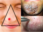 Làm đẹp - Liệt, mù… và nhiều hậu quả kinh khủng khác nếu bạn nặn mụn “vô tổ chức”