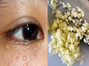 Làm đẹp - Mụn thịt dai dẳng sẽ "không cánh mà bay" nếu bạn biết cách này sớm hơn