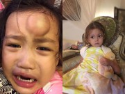 Làm mẹ - Con gái Vân Ốc sưng đầu, con Hồng Nhung từng gãy xương vì tai nạn trẻ nào cũng có thể gặp phải