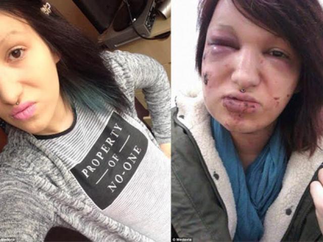 Cô gái xinh đẹp bị biến dạng vì tình cũ ghen tuông cắn 21 phát vào mặt