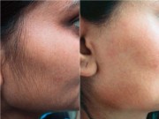 Làm đẹp - Mặt nạ thần kỳ tẩy sạch lông và mụn đầu đen trên mặt ngay tức khắc