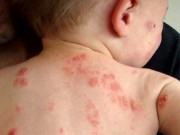 Tin tức - Vì sao mùa đông trẻ nhỏ, người lớn bị ngứa gãi đến chảy máu?