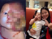 Làm mẹ - Cuộc sống mới của bé Việt mang khối u nửa khuôn mặt được nhà hảo tâm người Mỹ cứu sống
