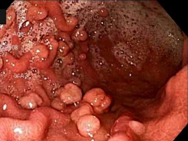 Mang bệnh này, 100% người sẽ bị ung thư sau tuổi 40