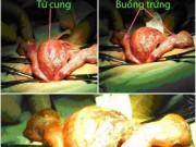 Tin tức - Hiếm gặp ở VN: Người đàn ông có tử cung và buồng trứng