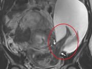 Bà bầu - Bức ảnh siêu âm thai nhi đạp thủng tử cung khiến mẹ "hốt hoảng"