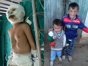 Tin tức - Cậu bé 4 tuổi bị bỏng xăng nguy kịch khi ở nhà một mình giờ ra sao?