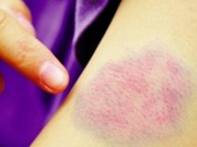 Sức khỏe - Vết bầm tím trên da cho thấy bạn mắc bệnh vô cùng nguy hiểm