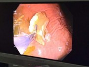 Tin tức - Người phụ nữ hốt hoảng phát hiện mẩu khung hàm và 3 răng giả trong dạ dày khi nội soi