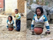 Làm mẹ - Bé gái tàn tật có nửa thân dưới là một quả bóng rổ, khi lớn khiến triệu người ngưỡng mộ