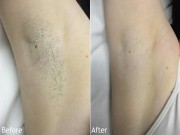 Làm đẹp - Nếu bạn đang khổ sở vì "viêm cánh", hãy tham khảo ngay 4 mẹo cực hay
