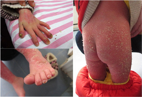 TQ: Bé gái 4 tuổi bị mụn rộp khắp người - 1