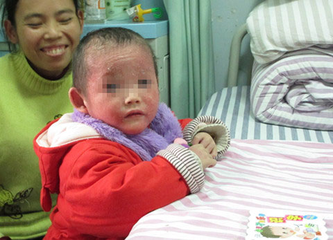 TQ: Bé gái 4 tuổi bị mụn rộp khắp người - 2