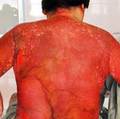 Tin tức - Lột da lưng do uống thực phẩm chức năng