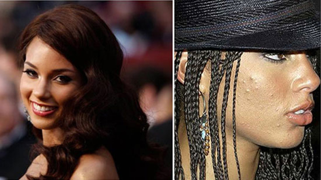 Alicia Keys, nữ ca sĩ nổi tiếng xinh đẹp cũng không tránh khỏi làn da nổi mụn.
