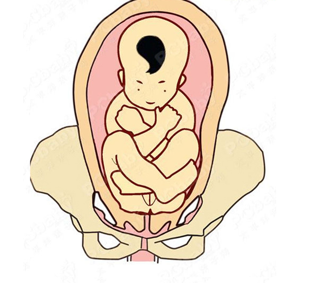 Trong các trường hợp xác định ngôi mông, bác sĩ thường chỉ định sinh mổ có chọn lọc, tức là không phải tất cả các trường hợp phải mổ. Tuy nhiên, vì muốn độ an toàn cao cho cả mẹ lẫn con nên bác sĩ chỉ định cho mổ nhiều hơn.
