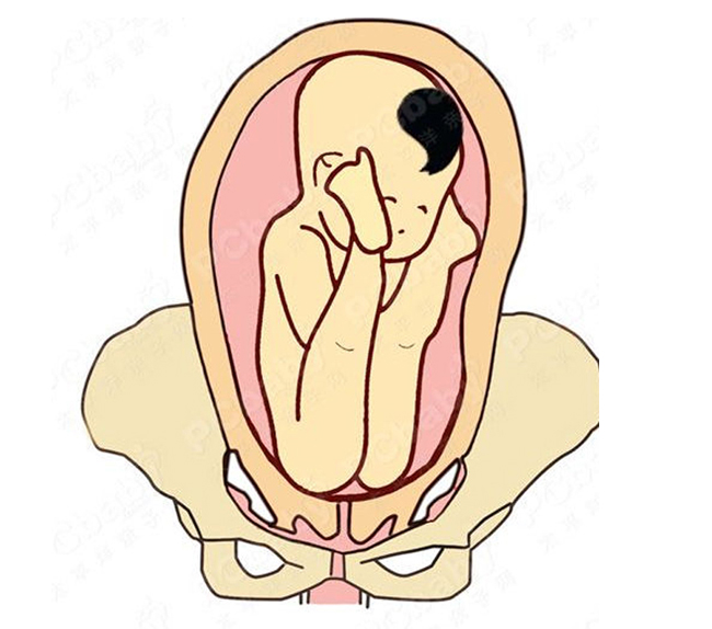 Có rất nhiều kiểu ngôi mông như trong ảnh, hai chân thai nhi đưa lên cao. trường hợp này nên sinh mổ.
