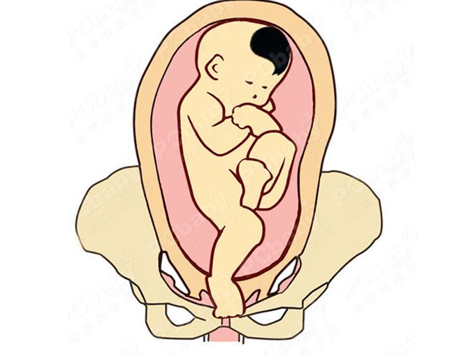 Kiểu ngôi thai này hiếm gặp nhưng nếu rơi vào trường hợp này mẹ sẽ được chỉ định đẻ mổ để an toàn cho bé.
