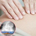 Bà bầu - Lạ: Thai nhi nằm trong bụng mẹ 44 năm
