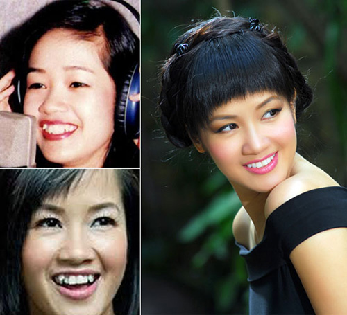 HH Ngọc Hân khác thế nào sau làm răng? - 12