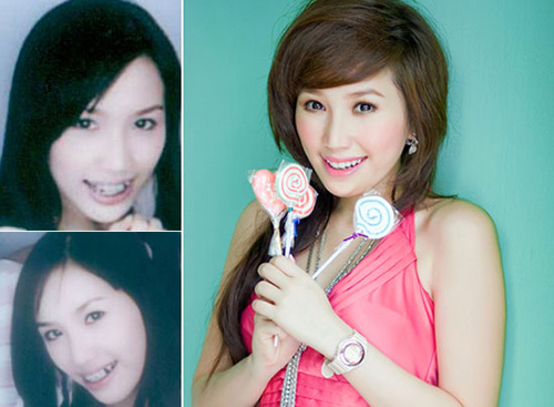 HH Ngọc Hân khác thế nào sau làm răng? - 13