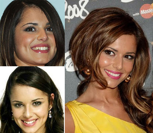 HH Ngọc Hân khác thế nào sau làm răng? - 15