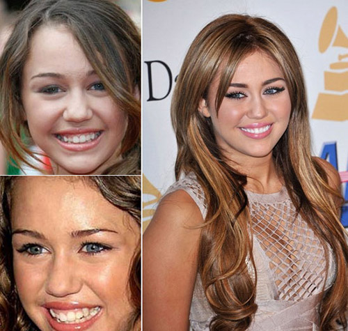 HH Ngọc Hân khác thế nào sau làm răng? - 16