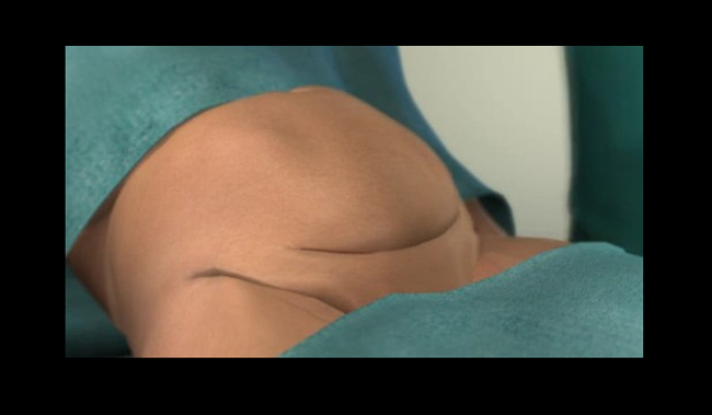 Ưu điểm lớn nhất của đường mổ ngang là vết sẹo sau khi mổ đẻ sẽ được ẩn dưới nếp ngấn của bụng nên sẽ không bị lộ. Vị trí của vết mổ ngang cũng giúp bác sĩ dễ dàng tiếp xúc với tử cung và đầu của thai nhi. Vì vậy, có đến 90% sản phụ chọn cách mổ ngang. Dưới đây là tường tận một ca mổ ngang lấy thai, mời chị em cùng theo dõi.

Trong ảnh: Bước 1: Bác sĩ đặt những vết dao mổ đầu tiên trên bụng mẹ bầu.

BÀI LIÊN QUAN

Xúc động bộ ảnh 265 ngày vợ mang bầu

Cận cảnh ca sinh đôi cách nhau 13 giờ

Vú sữa: Bà bầu đừng bỏ qua!

Lạ: Thai nhi nằm trong bụng mẹ 44 năm

Lá thư ngọt ngào gửi vợ bầu ngày Valentine

12 kiểu ngôi thai khiến bác sĩ ‘đau đầu’

