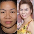 Làm đẹp - U50 Sài Gòn thành mỹ nhân sau ‘dao kéo’