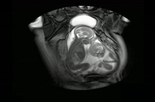 Cặp song thai #039;đá nhau#039; trong bụng mẹ - 1