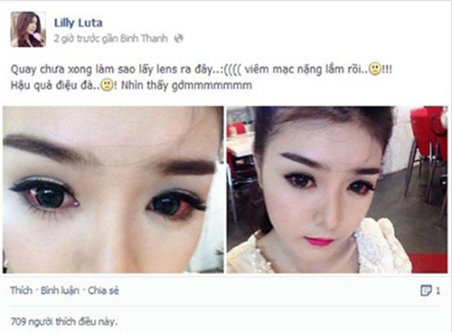 Hot girl Việt viêm giác mạc vì làm đẹp - 3