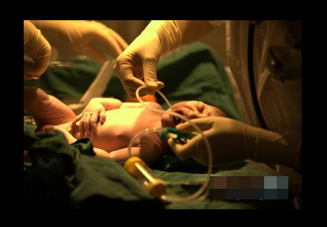 Sau khi chào đời, bé sơ sinh nhanh chóng được bác sĩ vệ sinh và thông đờm, dãi.
