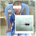 Tin tức - Bé 4 tuổi nuốt phải cây kim trong lúc lấy tủy răng