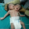 Làm mẹ - Sinh con 2 đầu vì không có tiền siêu âm