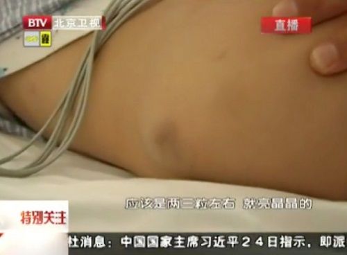 Bé trai 5 tuổi nhiễm độc thủy ngân nặng - 3