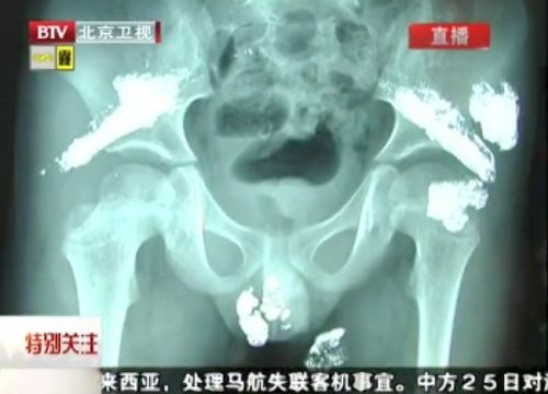 Bé trai 5 tuổi nhiễm độc thủy ngân nặng - 4