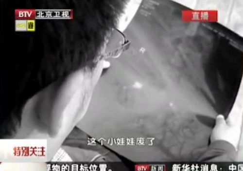 Bé trai 5 tuổi nhiễm độc thủy ngân nặng - 5