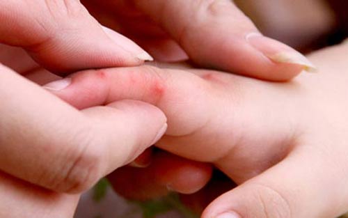 Hà Nội xuất hiện 5 ổ dịch tay chân miệng - 1