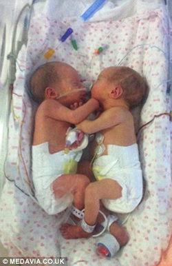 Cặp song thai chung bọc ối sống sót kỳ diệu - 5