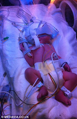 Cặp song thai chung bọc ối sống sót kỳ diệu - 6