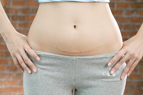 Vài chiêu giúp vết sẹo đẻ mổ không bị lồi - 1