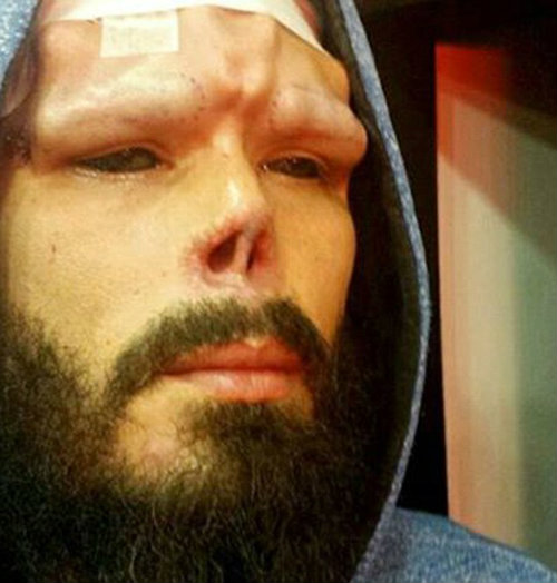 Bủn rủn với mốt cấy ghép dưới da để giống ‘thần tượng’ - 6