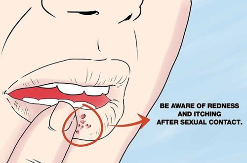 Dấu hiệu nhận biết bệnh Herpes sinh dục - 3