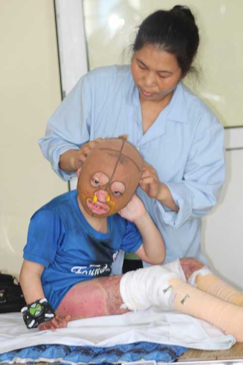Cậu bé bỏng xăng toàn thân bây giờ ra sao? - 2