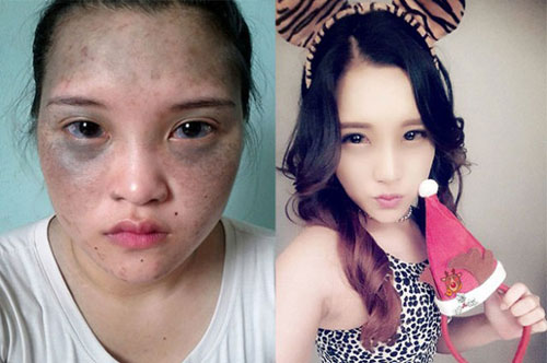 So độ #039;lột xác#039; của 10 thiếu nữ Việt sau dao kéo - 3